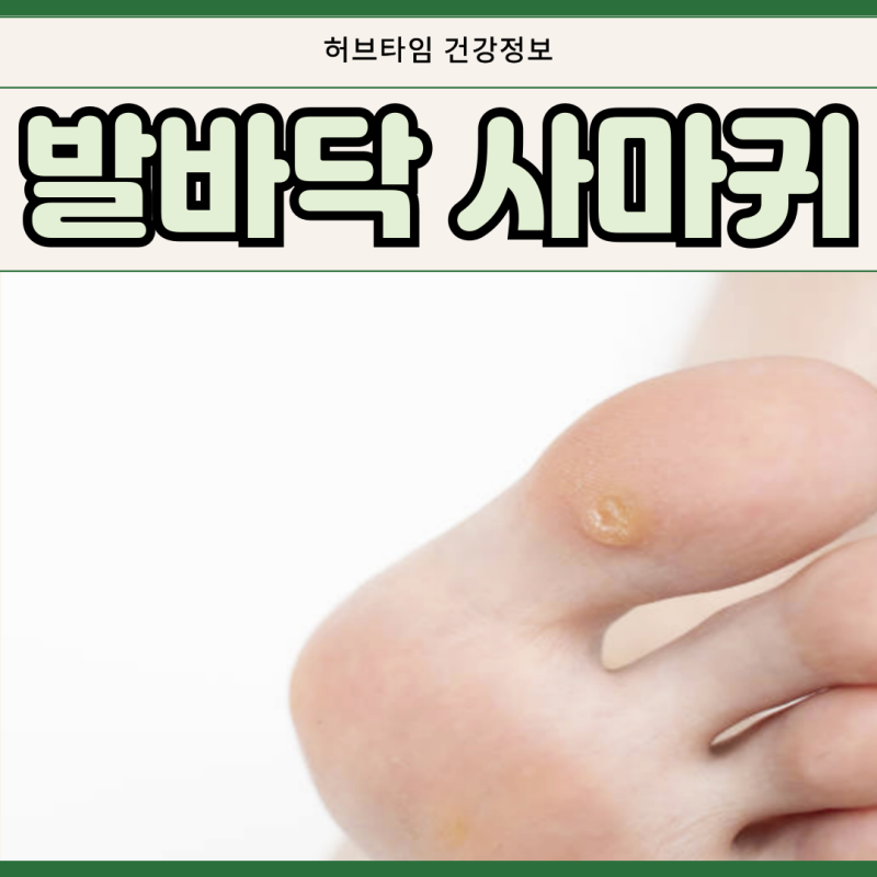 발가락 사마귀 원인 냉동치료 가격 실비 가능한지
