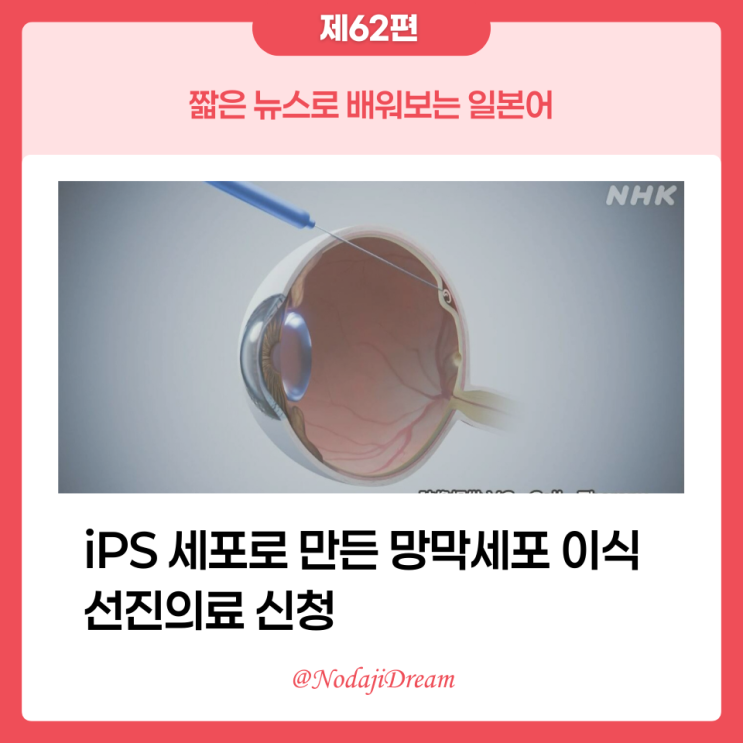  일본어 뉴스: iPS 세포로 만든 망막세포 이식, 선진의료 신청