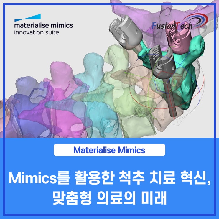 [Materialise S/W] Mimics를 활용한 척추 치료 혁신, 맞춤형 의료의 미래