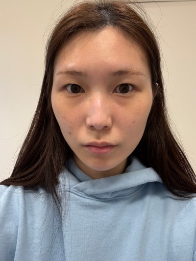 홍대 필러카세 2주 리얼후기 - 이마·관자·입술·귀족 필러 전후 변화 (사진) & 통증·붓기·시술 과정 총정리