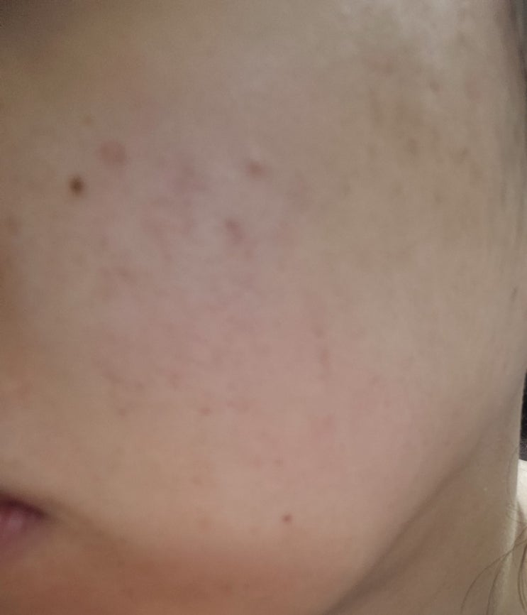  여드름, 색소침착, 기미, 주근깨 에 효과적인 피코토닝 레이저 찐 후기