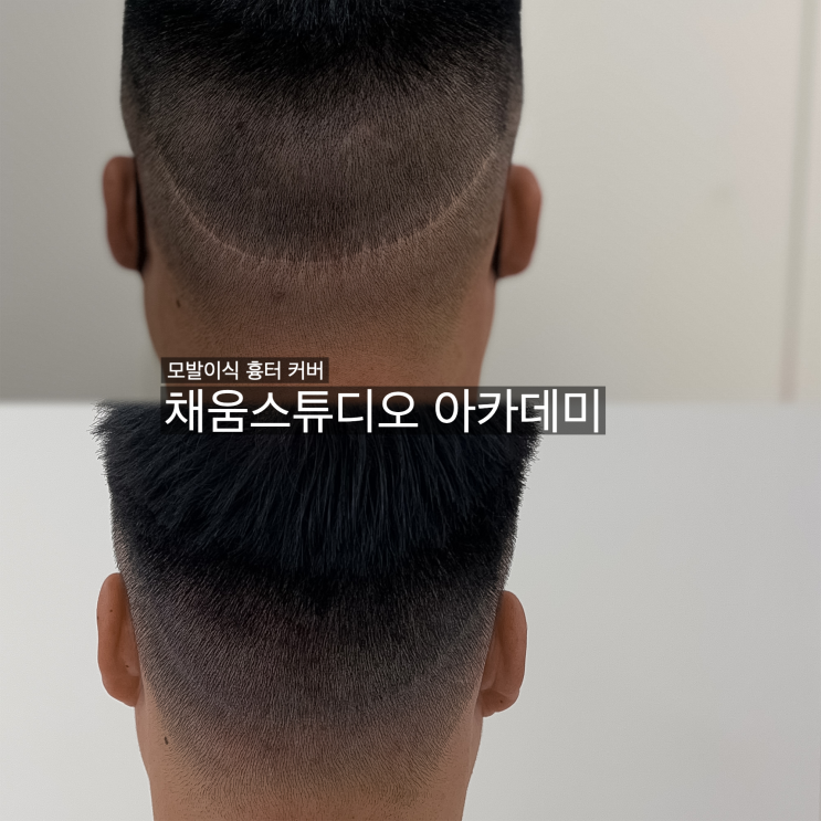  광주 흉터 커버 과정과 가격 공개합니다