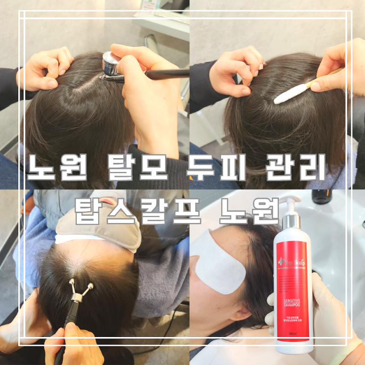  두피 스케일링 노원 탈모 관리 탑스칼프 노원점 후기