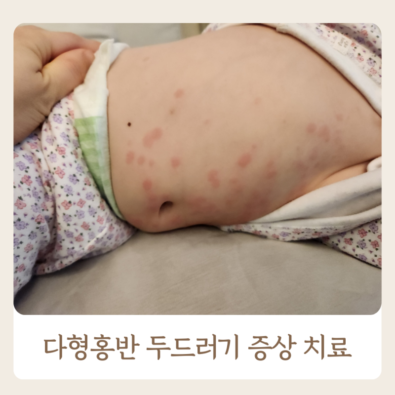 돌아기 다형홍반 증상 급성 두드러기 원인 치료