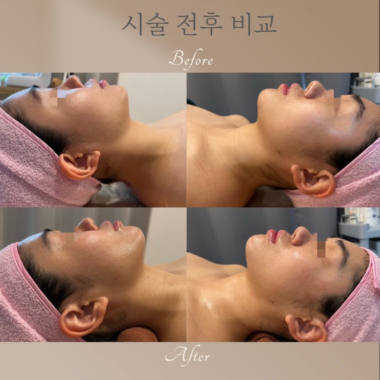  동래피부관리 비본스킨앤바디 리프팅탄력관리
