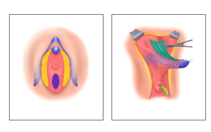  FtM 성기 재건 수술 메토이디오 Metoidioplasty 음경 재건