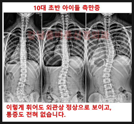 각도가 20도가 넘어가는 중학생 척추측만증은 반드시 전문병원에서 교정기를 사용해야 수술....