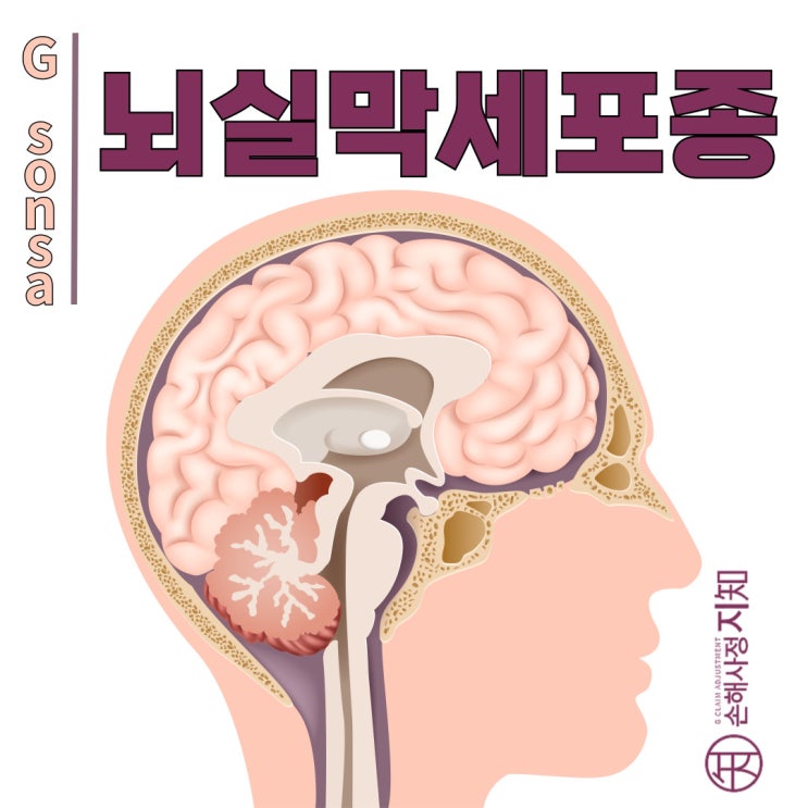  뇌실막세포종, 조용히 뇌를 압박하는 종양 - [아이 질병, 2부]