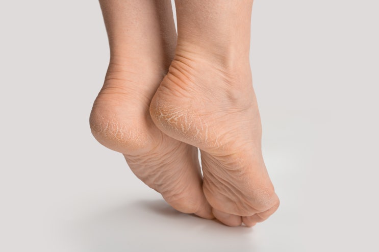  발바닥 무좀 증상, 발바닥 가려움, 발가락 무좀 치료, 발의 건강과 관련된 주요 문제와 해