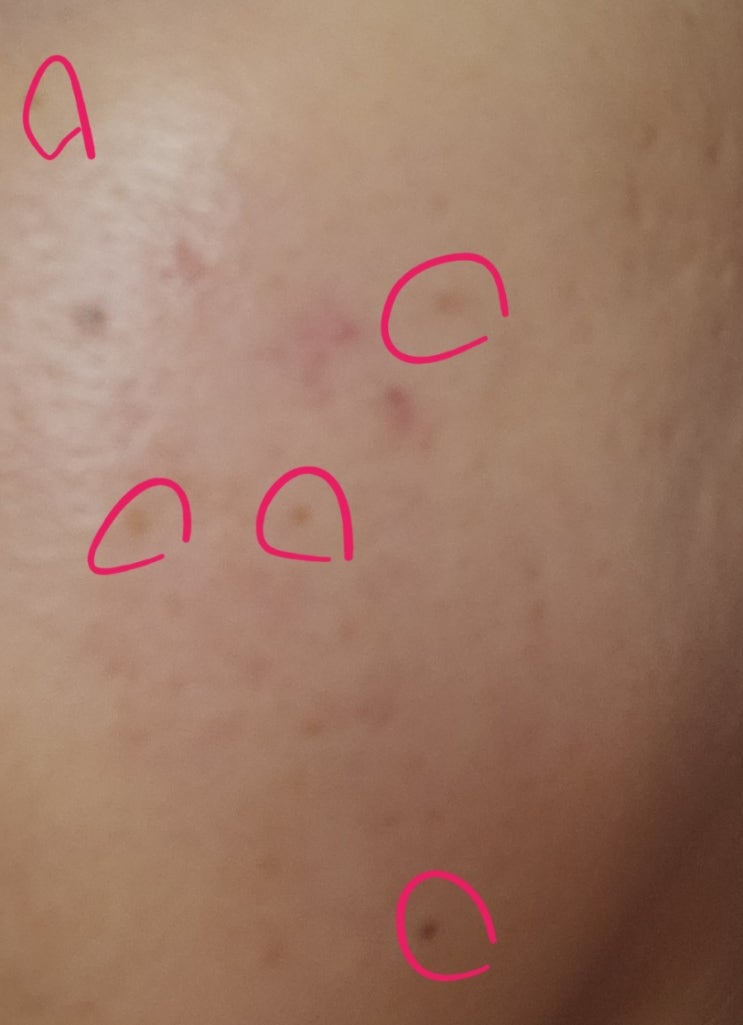  [일산피부과추천]; 주근깨, 기미, 흑자에 효과적인 엑셀토닝 레이저 후기