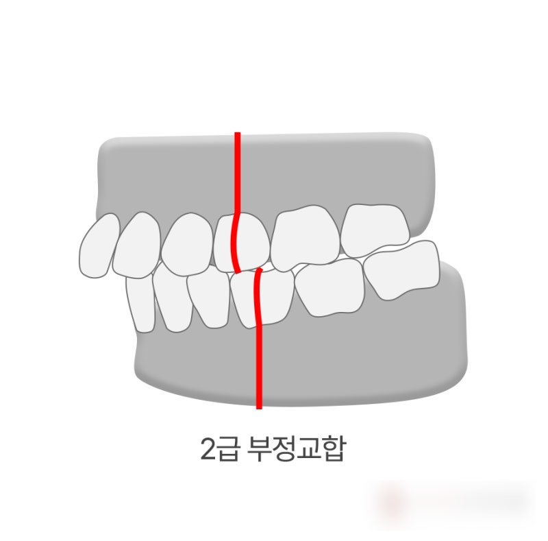 부정교합 종류 정리 1편 - 1급, 2급, 3급 부정교합이란?