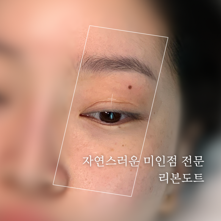  부산 미인점 시술, 30분 만에 받고 얼태기 극복하기