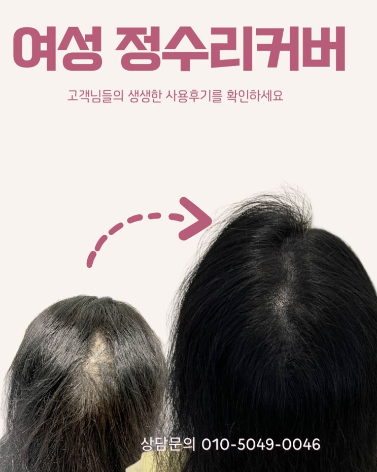  운양동두피문신: 여성탈모커버 후 머리자신있게 묶을 수 있어요