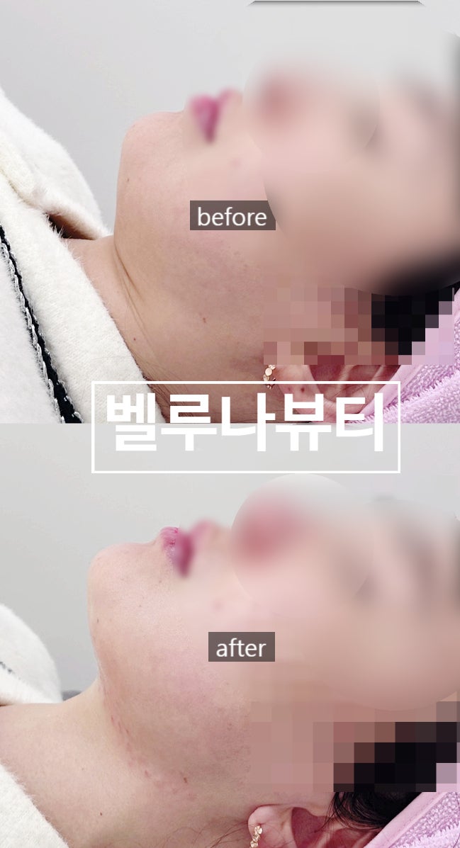  [대구/중구]대구 통증없는 이중턱리프팅 전문 벨루나뷰티