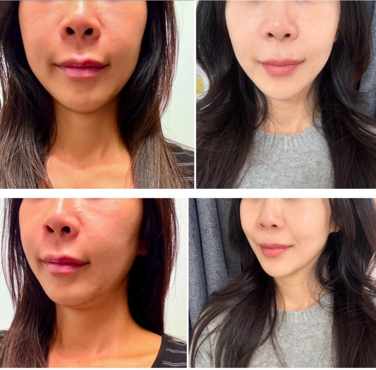  명동 미술관피부과 울쎄라 리프팅 300샷 효과 솔직후기
