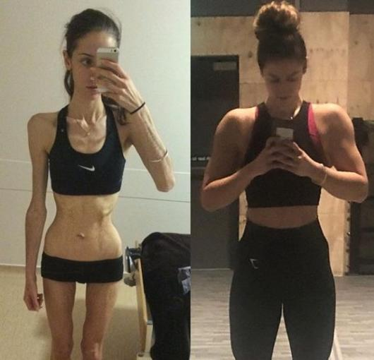 거식증(Anorexia) 초기 증상, 원인, 치료, 극복하기