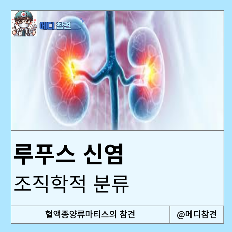 루프스 신염 Lupus Nephritis