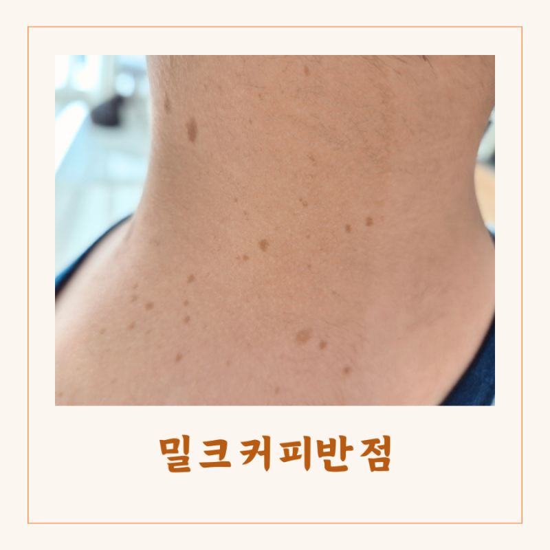 아기 신경섬유종 밀크반점 차이 유전 증상 : 네이버 블로그