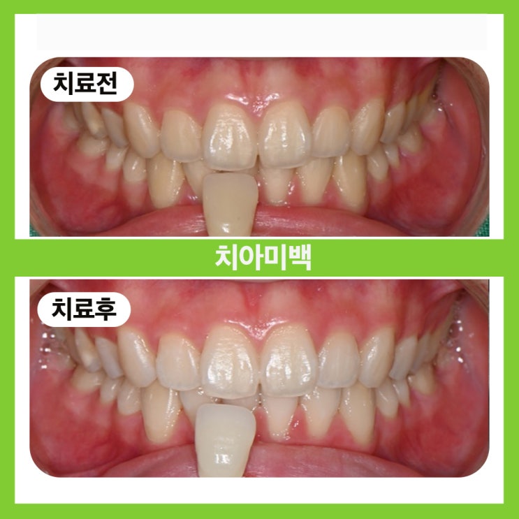  송파구치아미백 누런치아로 고민하고 계시다면?