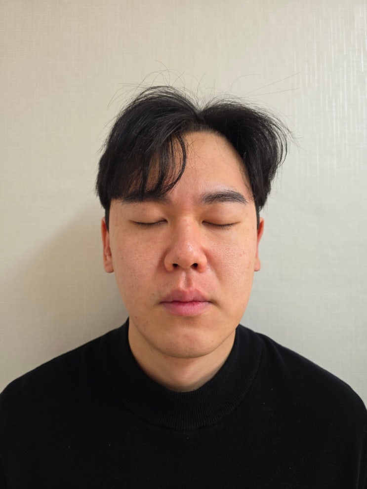  삼성역레이저제모 수염 영구 제모 7회차 후기
