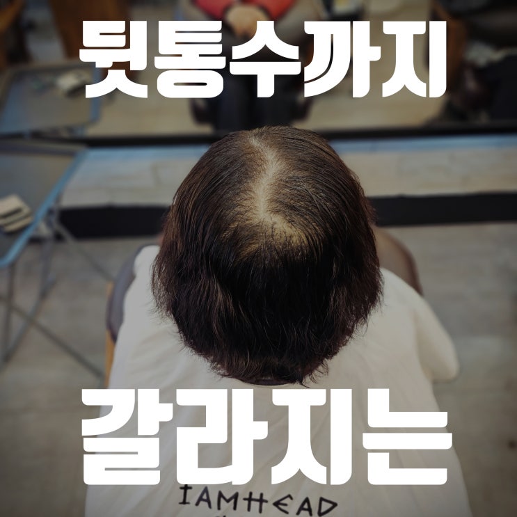  납작한 뒷통수와 가르마 갈라짐, 50대 여성의 가르마교정 링거펌 시술 후기