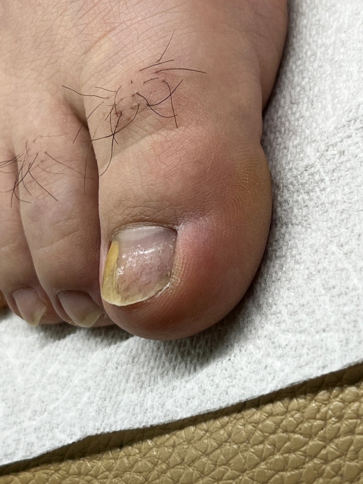 <b>대전</b> 내성발톱 안아프게 케어했어요