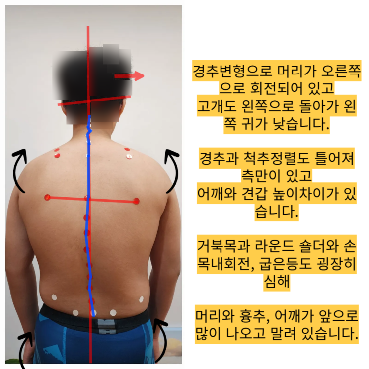  [동래 온천동 거북목교정] 거북목, 여러군데 가봤는데 교정이 안된다면?
