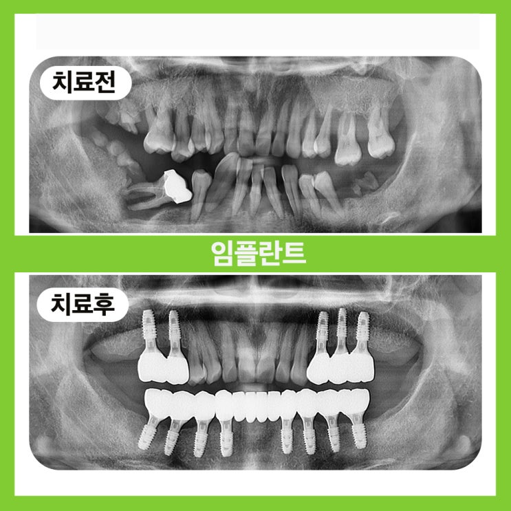  송파구임플란트치과 모든과정을 꼼꼼하게 진행하는