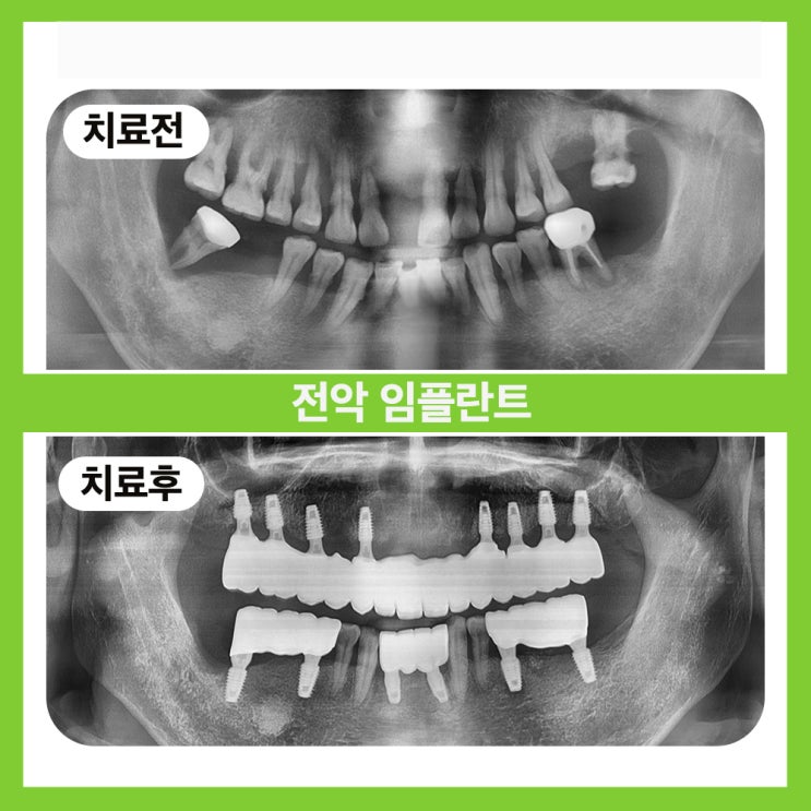  송파구임플란트, 잘하는곳을 찾으신다면? 서울오브치과로!