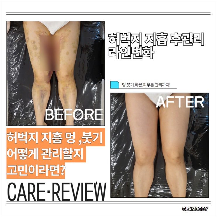  허벅지 지흡 멍 붓기 관리 사례