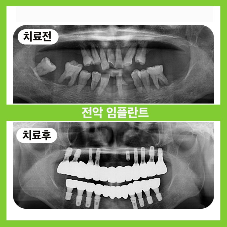  송파구치과추천 전악임플란트로 편안한 식사를 도와드렸어요!
