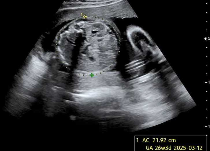  아빠의 임신일기 14. 뾱이 임신 26주차3일(26w3d) 산부인과 초음파