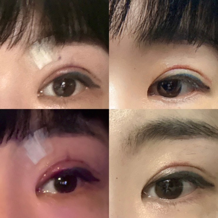  “쌍수재수술찐후기|매몰에서절개, 붓기관리수술후세안/머리감는방법, 회복 꿀팁 총정리!”