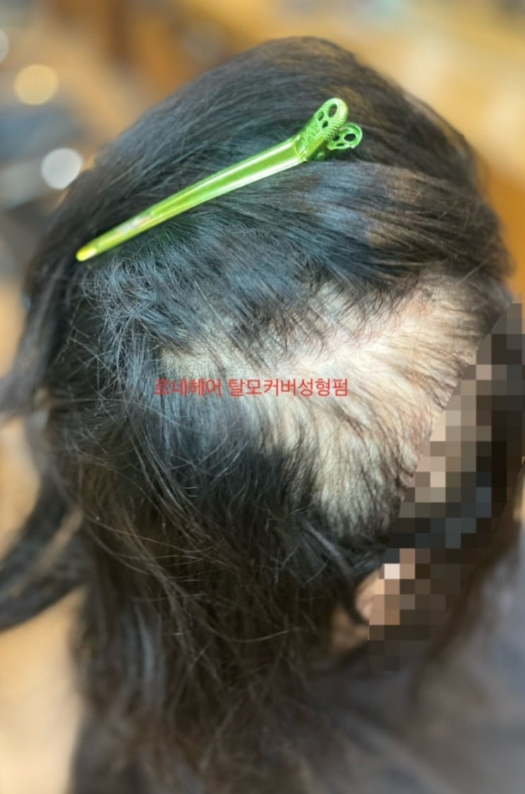  여성탈모흉터모발손상한번에 원스톱 원탑케어 부산엄지척탈모및케어전문미용실르네시떼6층헤어샵/ 감전사하개금덕천김해명지녹산장유대저울산양산덕계신평전포서면부전양정수영망미동래명륜해운대광안수영