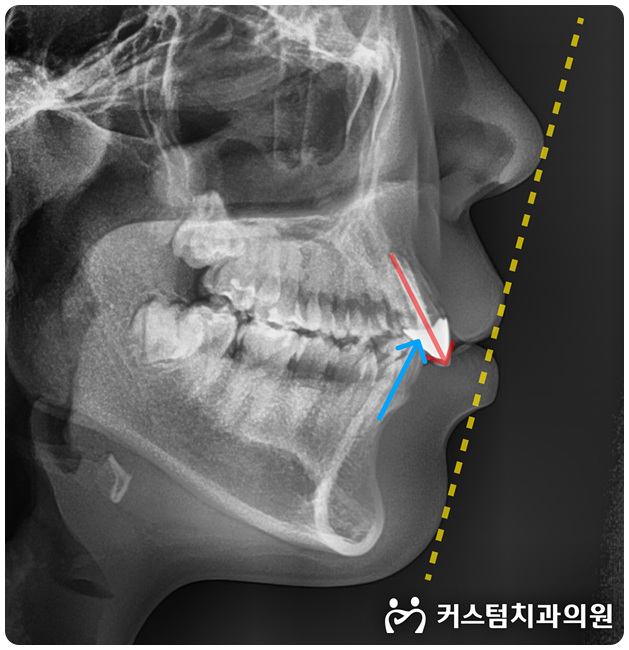  부천치아교정치과 전체교정에서 참고할 점