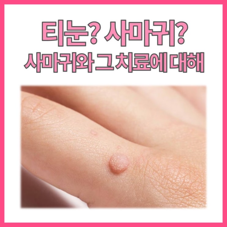  이게 티눈이 아니라 사마귀라고요? 헷갈리는 이유 & 치료법!