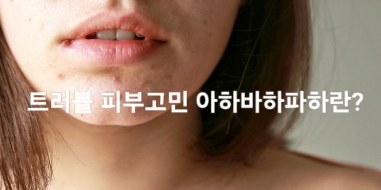  트러블 케어 화장품에 주로 사용되는 아하 바하 파하 센텔라 시카란? - 피부 재생 미백 항염 모공 청소 피지 항산화 등 ( AHA, BHA, PHA )