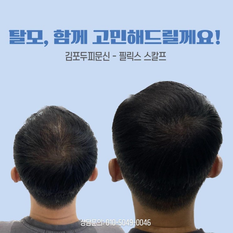  검단두피문신: 시술 시 주의해야 할 5가지