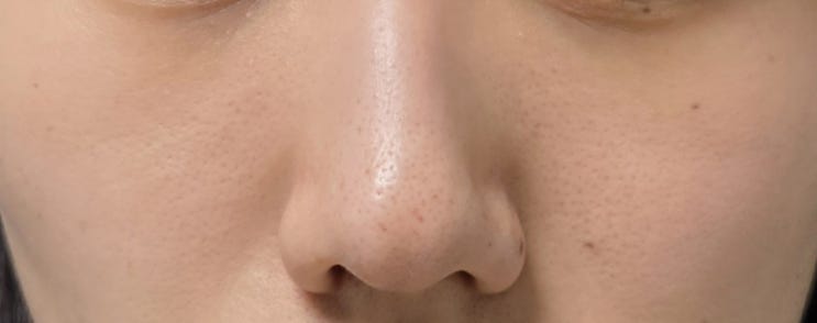  [이지뷰티랩] 은평구 모공관리 콜드 플라즈마 후기