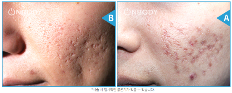 [온바디한의원 QnA] 새살침붉은기 언제 없어지나요?