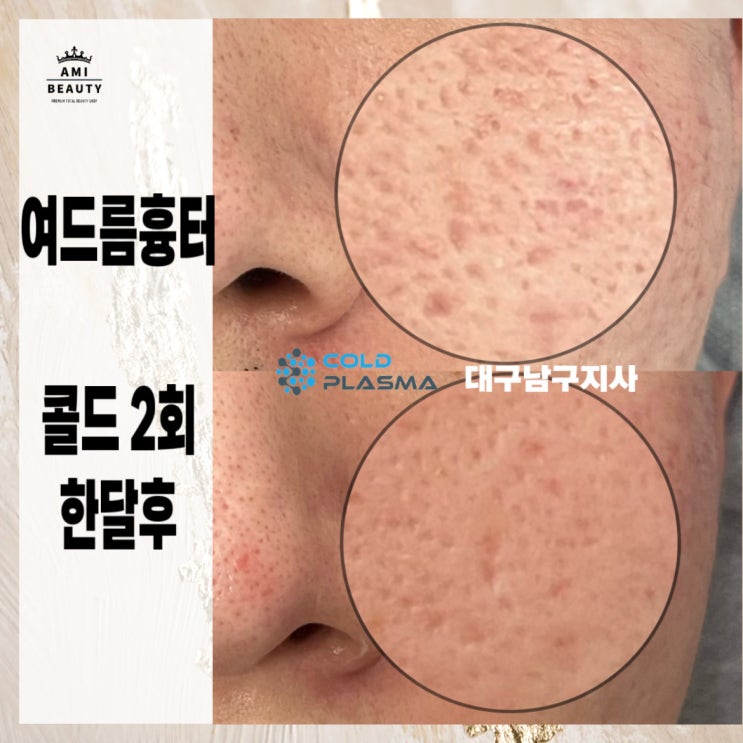  [대구 피부관리] 여드름 흉터, 아미뷰티 플라즈마 시술로 새로운 피부를 만나세요!