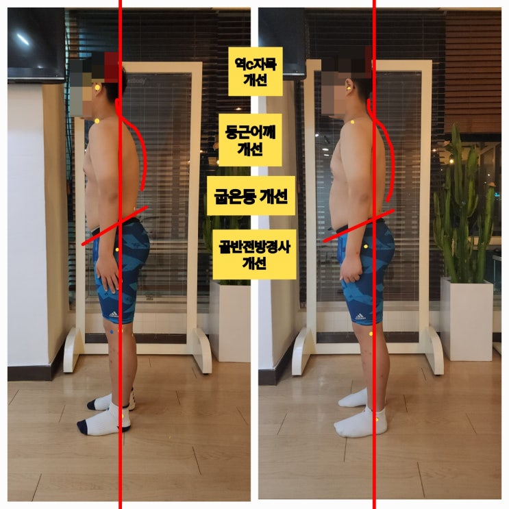  [동래 사직동 체형교정] 내 아이 자세교정, 10회 레슨 후 비포에프터