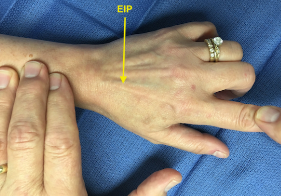 Hand-EPL rupture- EIP transfer 장무지신전근 파열 - 인지 고유 신전건 이전술 PL graft 장장건 ...