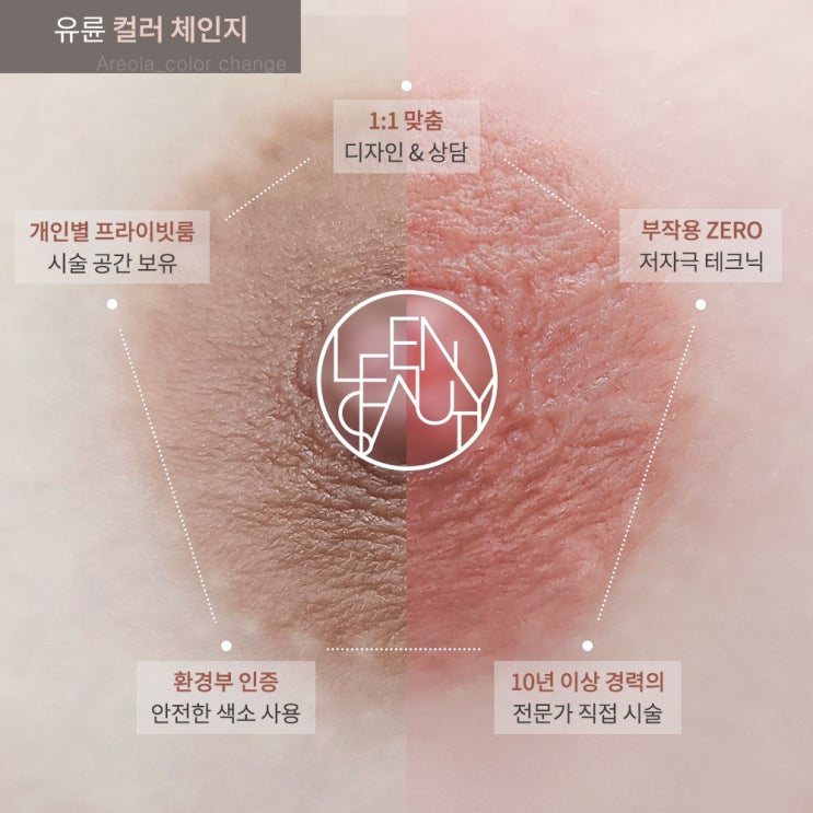  유두, 유륜착색 원인 및 미백방법