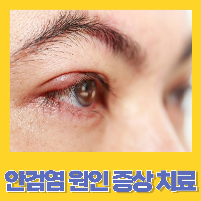눈꺼풀에 염증 생기는 안검염 원인 증상 치료법