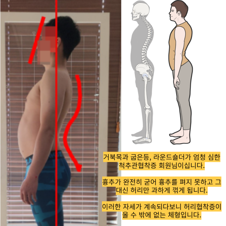  사직동 거북목•라운드숄더 교정, 많은 교정과 마사지에도 그대로라면?