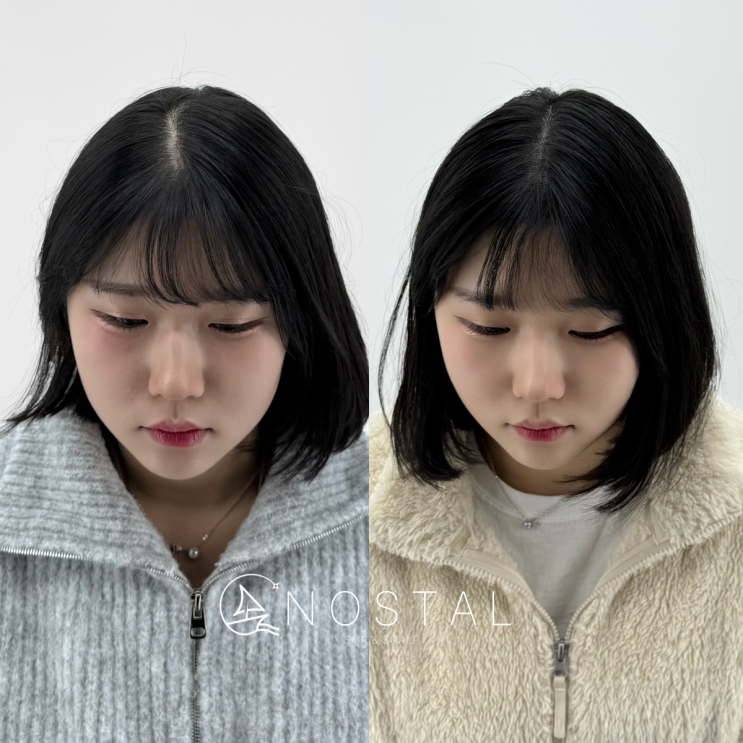  탈모, 이제는 20대도 고민하는 시대
