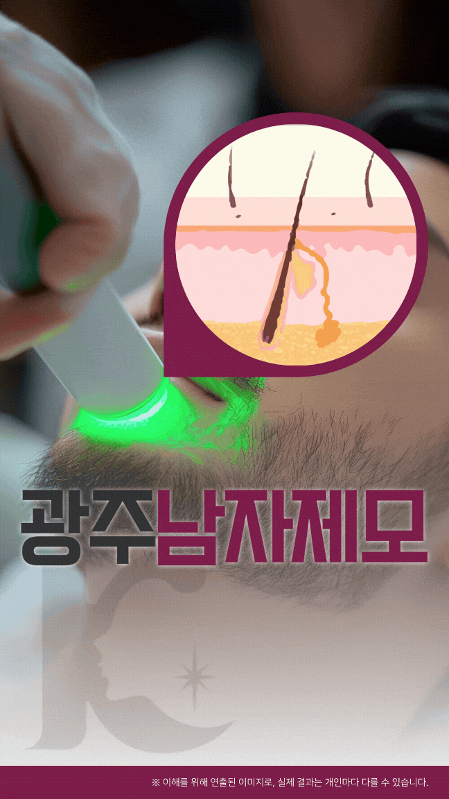  광주 남자제모 턱수염 개선에 필요한 레이저는