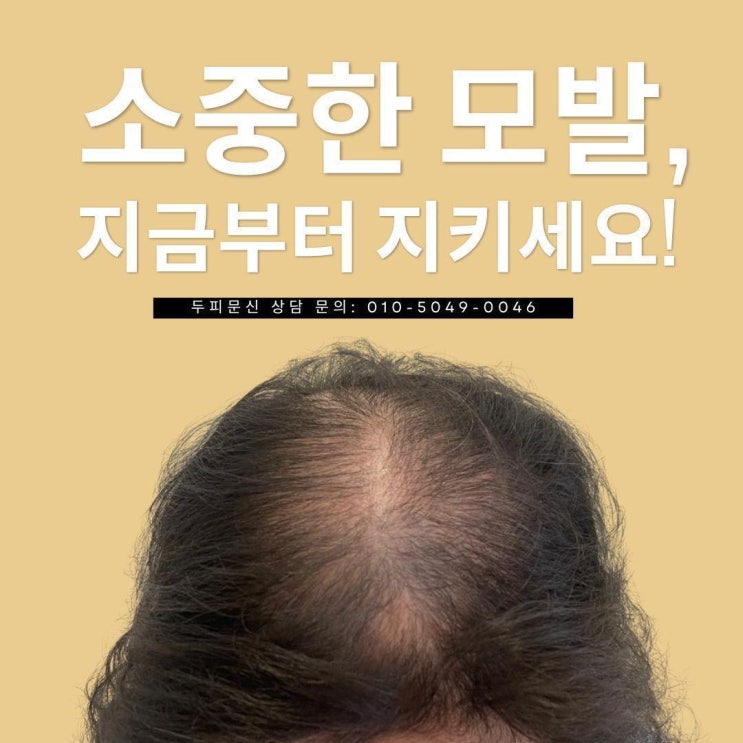  청라두피문신: 전문가가 말하는 시술의 장단점