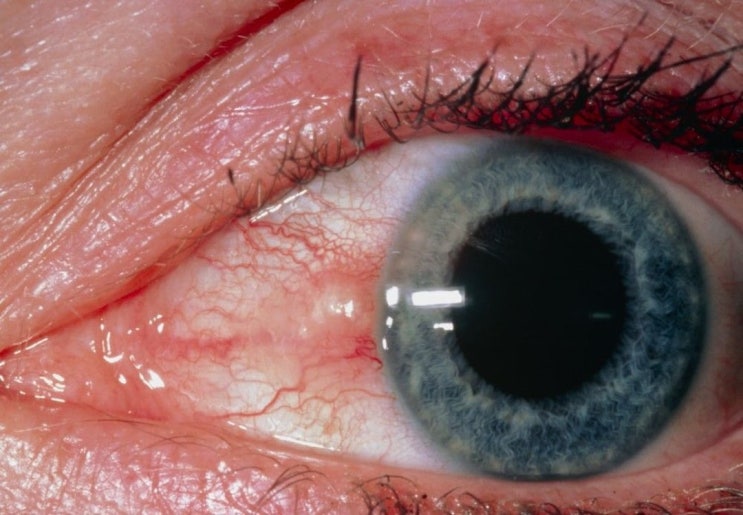 핑게큘라(Pinguecula)와 익룡(Pterygium)